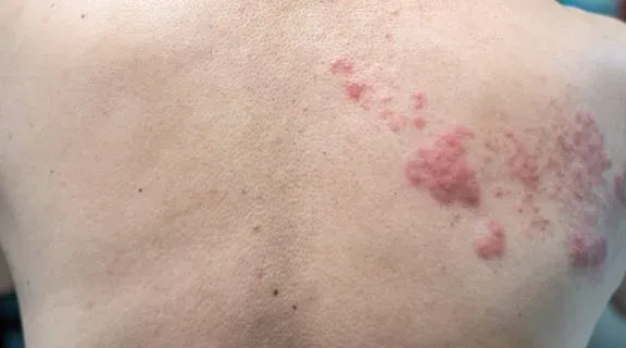 O que pode piorar a herpes zoster: veja quais são os fatores de risco