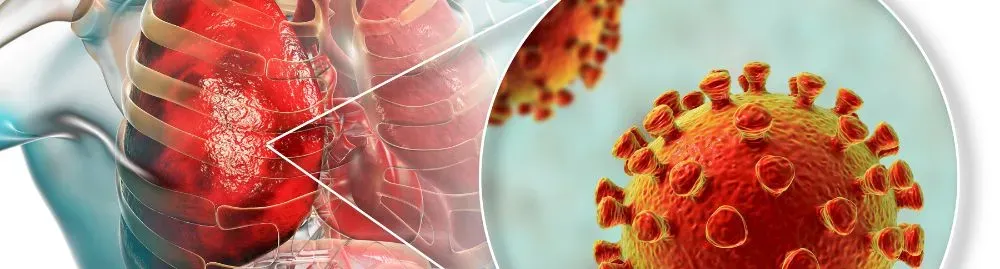 pneumonia viral tratamento​1.webp