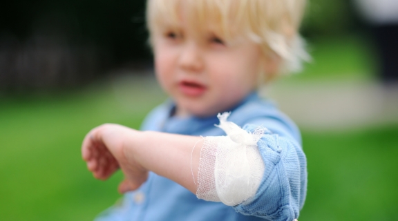 Queimadura infantil: primeiros socorros para proteger a criança