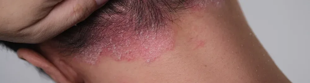 psoríase na cabeça1.webp