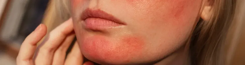 psoríase no rosto1.webp