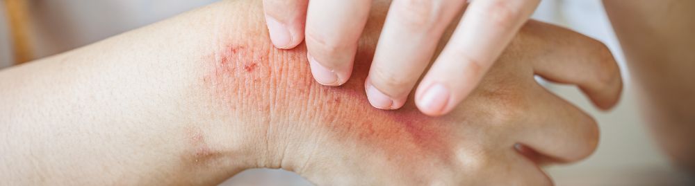 quais os tipos de alergia&nbsp;na&nbsp;pele1.jpg