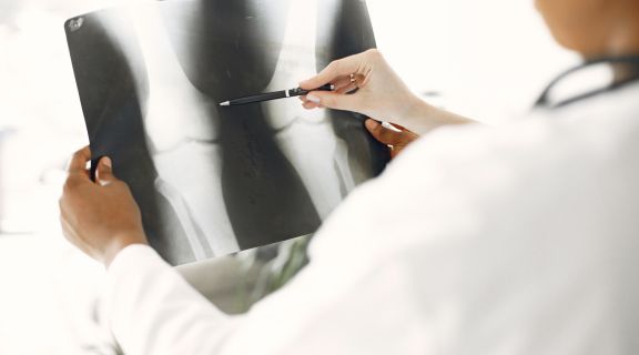 Quando a osteoporose é grave e exige atenção? Veja como identificar e tratar