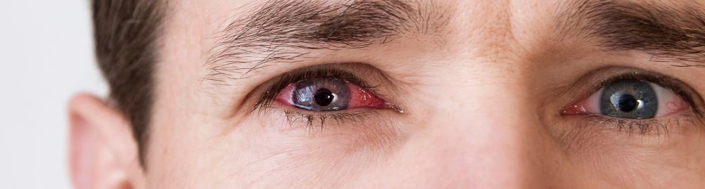 quantos dias dura a conjuntivite​1.jpg