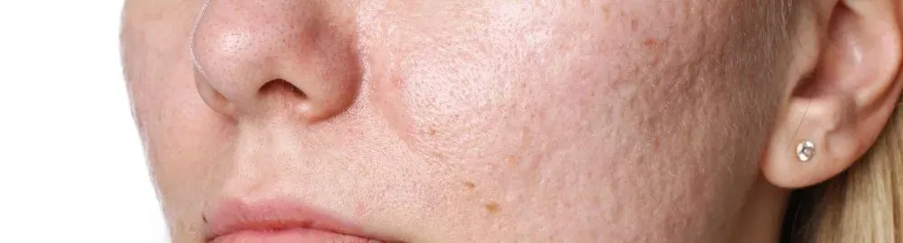 rosácea papulopustulosa1.webp