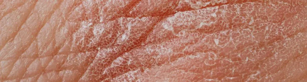 sintomas catapora1.webp