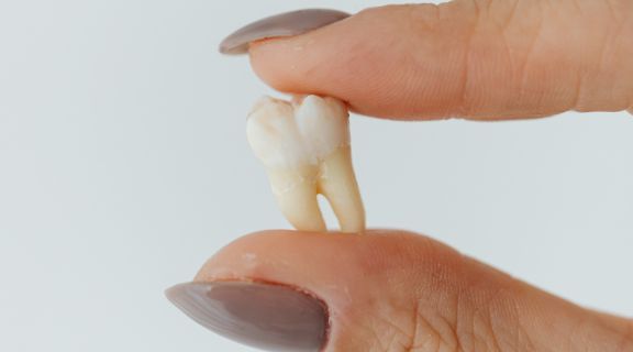 Sintomas de infecção no dente extraído: saiba quando se preocupar