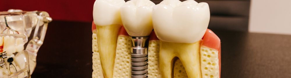 sintomas de infecção no implante dentário​1.jpg