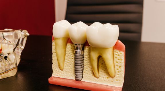 Sintomas de infecção no implante dentário: quando se preocupar?