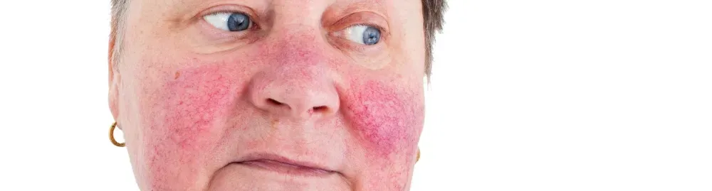 sintomas de rosácea1.webp