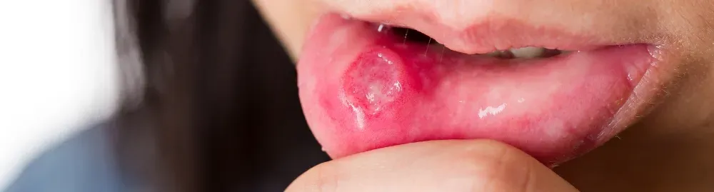 sintomas de sífilis na boca1.webp