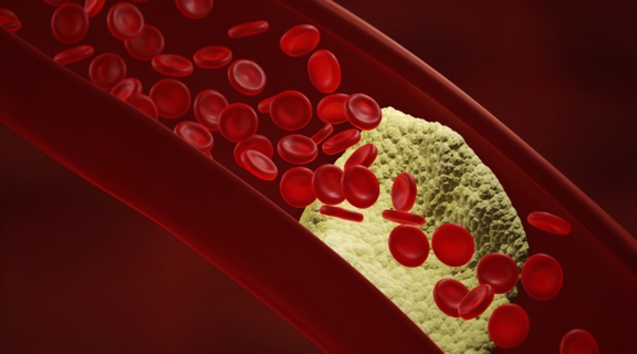 Tipos de aterosclerose: como a doença afeta diferentes partes do corpo