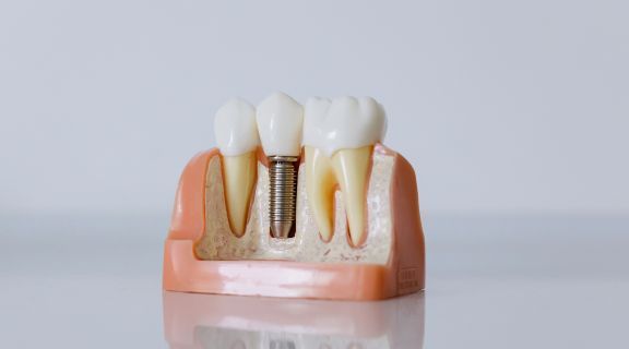 Tipos de implante dentário: veja quais são os materiais usados e escolhidos