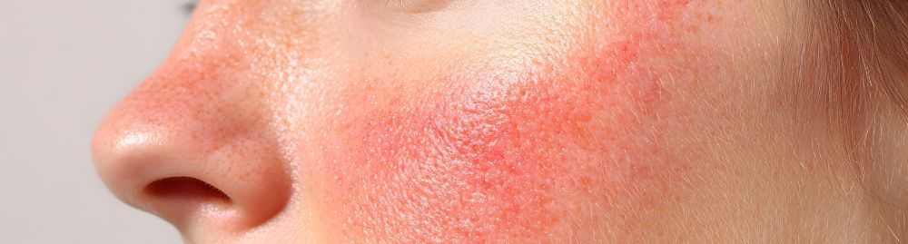 tipos de rosácea​1.jpg