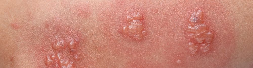 transmissão do herpes zoster​1.jpg