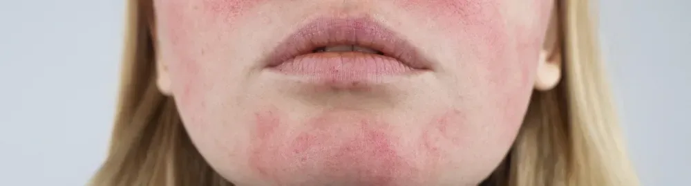 tratamento rosácea​1.webp