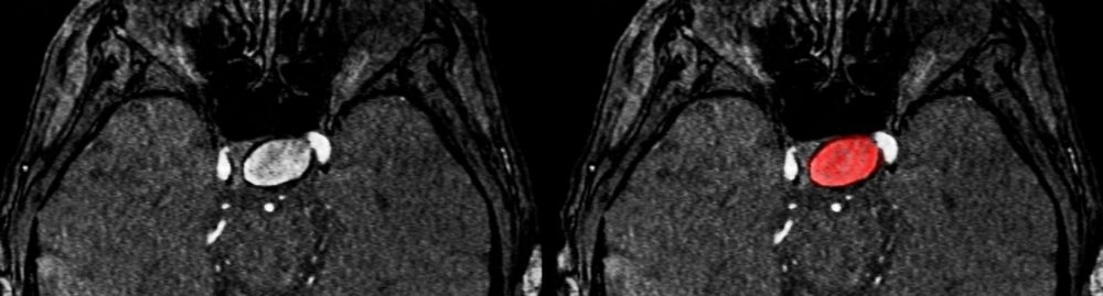 tratamentos para aneurisma cerebral​1.webp