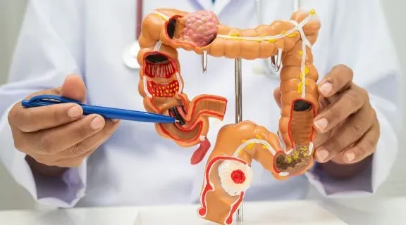 Tratamentos para o câncer colorretal: veja quais estão disponíveis