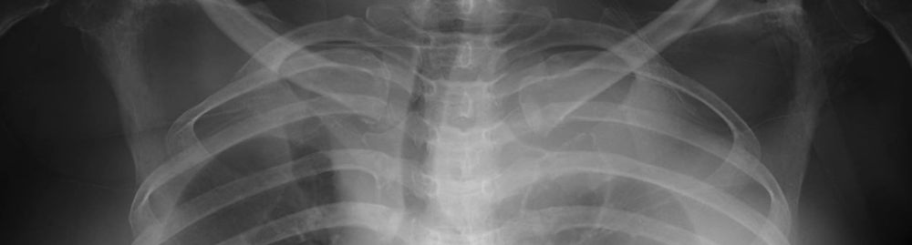 tratamentos para derrame pleural1.jpg