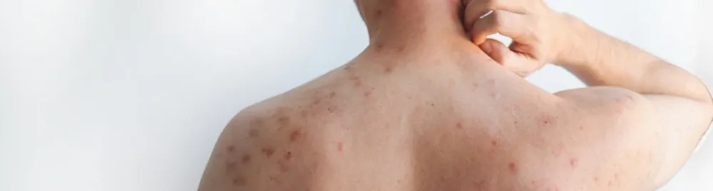 tratamentos para sarampo1.webp