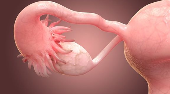 Câncer nos ovários