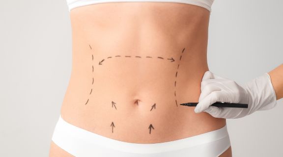 abdominoplastia