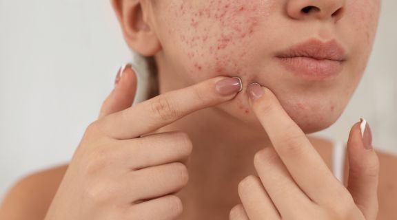 como prevenir espinhas