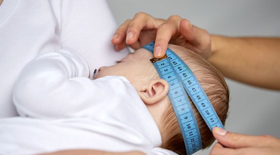 bebê com cranioestenose