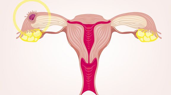 útero com gravidez ectópica