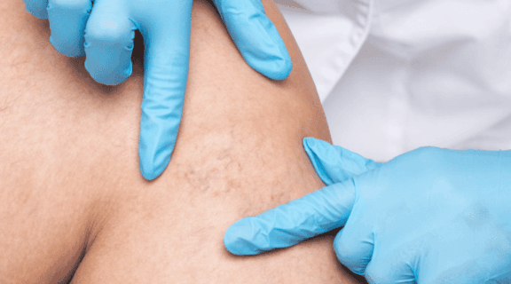 insuficiência venosa crônica