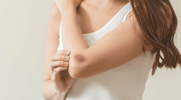 manchas roxas na pele