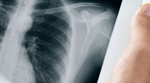 sintomas de câncer de pulmão