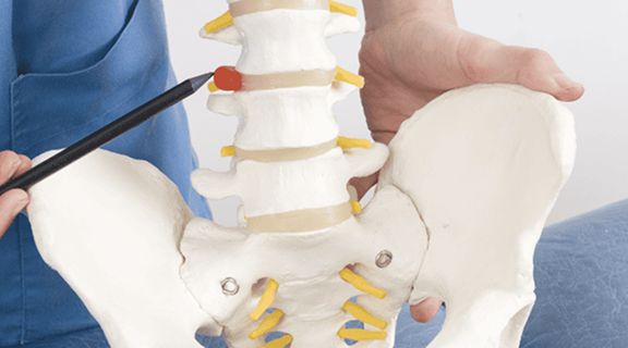 sintomas de hérnia de disco