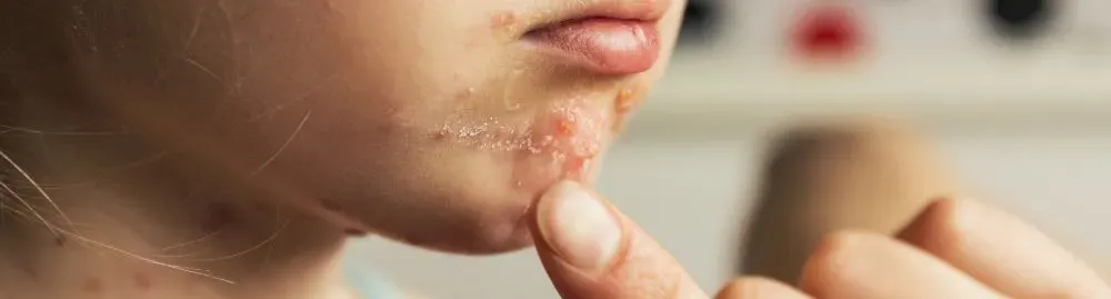 varicela é catapora1.webp