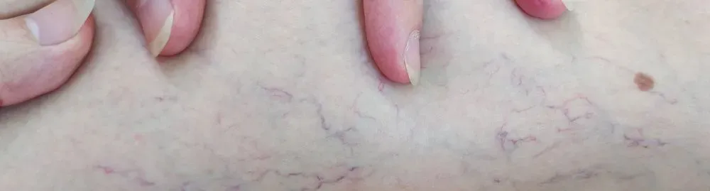 varizes nas pernas é perigoso_1.webp