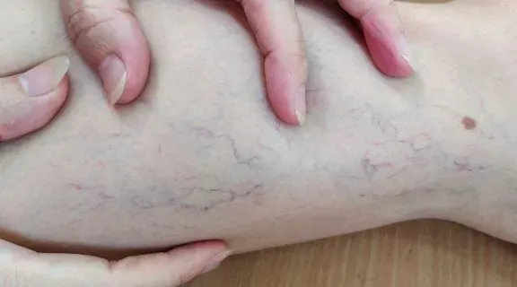 Varizes nas pernas: quando elas se tornam um perigo real?